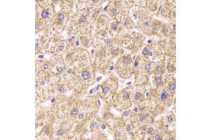Immunohistochemistry of paraffin-embedded Human liver injury using ST3GAL3 antibody at dilution of 1:100 (x400 lens). (ST3GAL3 抗体)