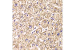 Immunohistochemistry of paraffin-embedded Human liver injury using ST3GAL3 antibody at dilution of 1:100 (x400 lens). (ST3GAL3 抗体)