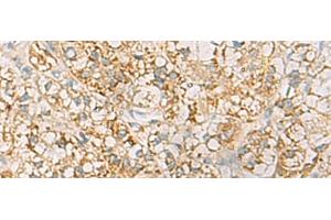 Immunohistochemistry of paraffin-embedded Human liver cancer tissue using HLA-DQB2 Polyclonal Antibody at dilution of 1:70(x200)