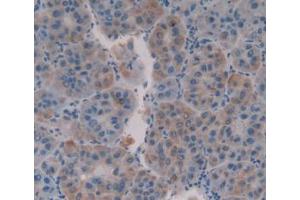 IHC-P analysis of Human Liver Cancer Tissue, with DAB staining. (MUC16 抗体  (AA 13977-14117))