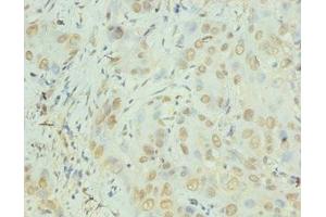 Immunohistochemistry of paraffin-embedded human liver cancer using ABIN7156933 at dilution of 1:100 (IL-8 抗体  (AA 23-99))