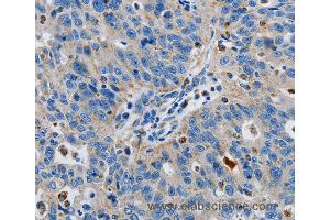 Immunohistochemistry of Human lung cancer using GRIA3 Polyclonal Antibody at dilution of 1:50 (Glutamate Receptor 3 抗体)