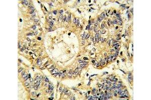 IHC analysis of FFPE human colon carcinoma stained with SOCS1 antibody (SOCS1 抗体  (AA 35-66))