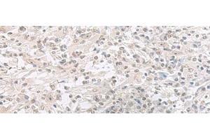 Immunohistochemistry of paraffin-embedded Human liver cancer tissue using ORC1 Polyclonal Antibody at dilution of 1:65(x200) (ORC1 抗体)
