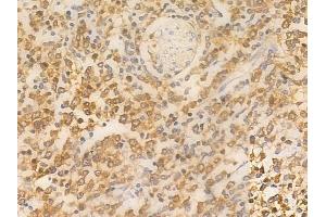 ABIN6260894 and ABIN6266702 at 1/100 staining human Hodgkin lymphoma by IHC-P. (CLOCK 抗体  (Internal Region))