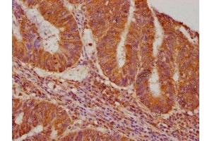 IHC image of ABIN7140215 diluted at 1:640 and staining in paraffin-embedded human colon cancer performed on a Leica BondTM system. (Vasn 抗体  (AA 553-572))