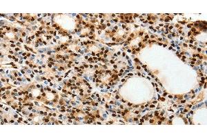 Immunohistochemistry of paraffin-embedded Human thyroid cancer using SPATA20 Polyclonal Antibody at dilution of 1:70 (SPATA20 抗体)