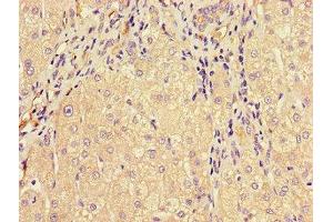 Immunohistochemistry of paraffin-embedded human liver cancer using ABIN7159734 at dilution of 1:100 (MTTP 抗体  (AA 19-151))