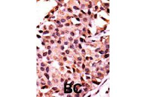 Formalin-fixed and paraffin-embedded human breast cancer tissue reacted with PPP3CC polyclonal antibody  , which was peroxidase-conjugated to the secondary antibody, followed by AEC staining. (PPP3CC 抗体  (N-Term))
