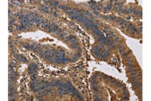 The image on the left is immunohistochemistry of paraffin-embedded Human colon cancer tissue using ABIN7191171(KCNG1 Antibody) at dilution 1/40, on the right is treated with synthetic peptide. (KCNG1 抗体)