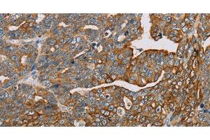 Immunohistochemistry of paraffin-embedded Human cervical cancer using MTFP1 Polyclonal Antibody at dilution of 1:30 (Mtfp1 抗体)