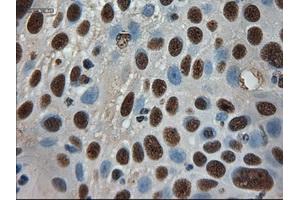 Immunohistochemical staining of paraffin-embedded Adenocarcinoma of breast using anti-AMY2A (ABIN2452539) mouse monoclonal antibody. (AMY2A 抗体  (AA 300-511))