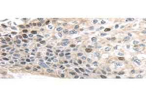 Immunohistochemistry of paraffin-embedded Human esophagus cancer using TPX2 Polyclonal Antibody at dilution of 1/40 (TPX2 抗体)