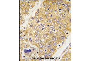 Formalin-fixed and paraffin-embedded human hepatocellular carcinoma reacted with Dtnbp1 polyclonal antibody  , which was peroxidase-conjugated to the secondary antibody, followed by DAB staining. (DTNBP1 抗体  (C-Term))