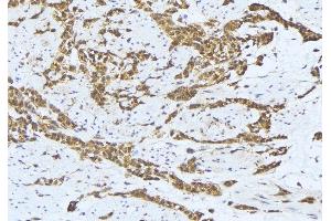 ABIN6275640 at 1/100 staining Human lung cancer tissue by IHC-P. (MTERF 抗体  (Internal Region))