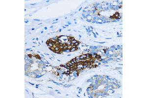 Immunohistochemistry of paraffin-embedded Human mammary cancer using EE antibody  at dilution of 1:100 (40x lens).