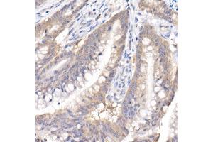 Immunohistochemistry of paraffin-embedded human colon carcinoma using SARA Rabbit mAb (ABIN7271559) at dilution of 1:50 (40x lens). (ZFYVE9 抗体)