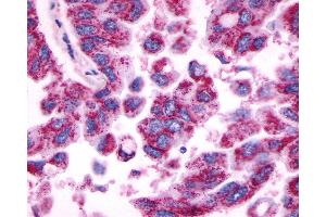 Anti-MRGPRE / MRGE antibody IHC of human Lung, Adenocarcinoma. (MRGPRE 抗体  (C-Term))
