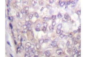 Immunohistochemistry analyzes of C-Raf antibody in paraffin-embedded human breast carcinoma tissue. (RAF1 抗体)