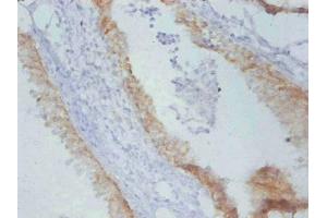 Immunohistochemistry of paraffin-embedded Rat prostate cancer using ABIN7179094 at dilution of 1:100. (TIMP1 抗体)