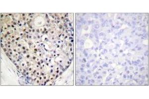 Immunohistochemistry analysis of paraffin-embedded human breast carcinoma, using CHOP (Phospho-Ser30) Antibody. (DDIT3 抗体  (pSer30))