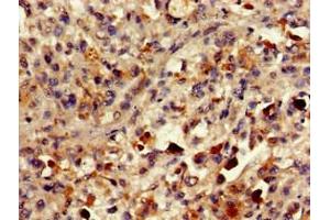 Immunohistochemistry of paraffin-embedded human melanoma using ABIN7154456 at dilution of 1:100 (PLA2G1 (AA 43-165) 抗体)