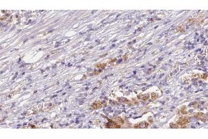 ABIN6272632 at 1/100 staining Human liver cancer tissue by IHC-P. (CD300LB 抗体  (C-Term))