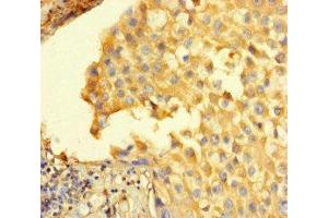 Immunohistochemistry of paraffin-embedded human breast cancer using ABIN7168626 at dilution of 1:100 (STIL 抗体  (AA 388-637))