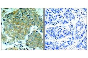 Immunohistochemical analysis of paraffin-embedded human breast carcinoma tissue using eIF2α (Phospho-Ser51) Antibody (left) or the same antibody preincubated with blocking peptide (right). (EIF2S1 抗体  (pSer51))