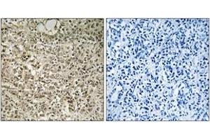 Immunohistochemistry analysis of paraffin-embedded human breast carcinoma tissue, using RPL40 Antibody. (UBA52 抗体  (AA 71-120))
