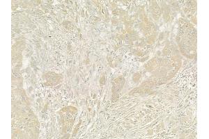 ABIN6260408 and ABIN6273204 at 1/100 staining human tongue carcinoma by IHC-P. (CALCOCO2 抗体  (Internal Region))