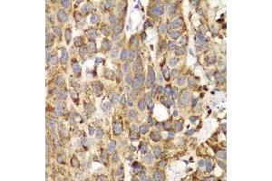Immunohistochemistry of paraffin-embedded human lung cancer using SHMT2 antibody at dilution of 1:100 (400x lens). (SHMT2 抗体)