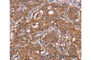 Immunohistochemistry of Human liver cancer using HMGCS1 Polyclonal Antibody at dilution of 1:40 (HMGCS1 抗体)