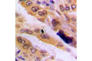 Immunohistochemical analysis of JNK2 staining in human lung cancer formalin fixed paraffin embedded tissue section. (JNK2 抗体  (Center))