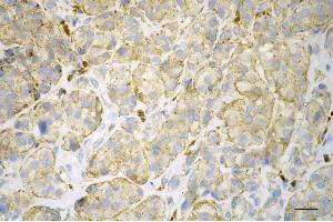 Immunohistochemistry was performed on paraffin-embedded human melanoma using ITGB1BP1 antibody (ABIN7799068), 1:200). (ITGB1BP1 抗体)