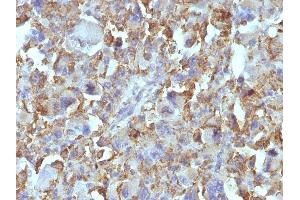 Formalin-fixed, paraffin-embedded human Histiocytoma stained with Macrophage Monoclonal Antibody (D11). (Macrophage / Histiocytoma Marker 抗体)