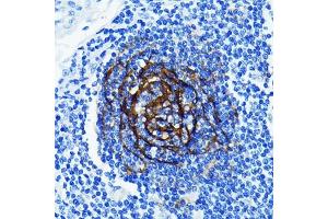 Immunohistochemistry of paraffin-embedded human lung cancer using p75NTR/NGFR Rabbit mAb (ABIN7268850) at dilution of 1:100 (40x lens). (NGFR 抗体)