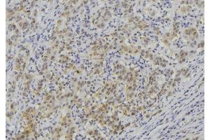 ABIN6273513 at 1/100 staining Human lung cancer tissue by IHC-P. (LAMC3 抗体  (Internal Region))