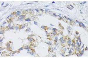 Immunohistochemistry of paraffin-embedded Human mammary cancer using SLC30A1 Polyclonal Antibody at dilution of 1:100 (40x lens). (SLC30A1 抗体)