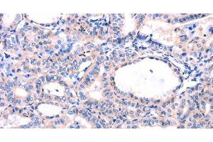 Immunohistochemistry of paraffin-embedded Human thyroid cancer tissue using DUSP12 Polyclonal Antibody at dilution 1:77 (DUSP12 抗体)