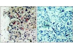 Immunohistochemistry analysis of paraffin-embedded human breast carcinoma tissue, using JAK1 (Ab-1022) Antibody. (JAK1 抗体  (AA 988-1037))