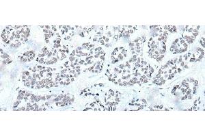 Immunohistochemistry of paraffin-embedded Human esophagus cancer tissue using BRD3 Polyclonal Antibody at dilution of 1:60(x200) (BRD3 抗体)