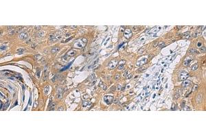Immunohistochemistry of paraffin-embedded Human esophagus cancer tissue using PA2G4 Polyclonal Antibody at dilution of 1:60(x200) (PA2G4 抗体)