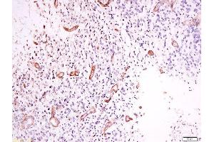 Formalin-fixed and paraffin embedded human neurological glioblastoma labeled with Anti-OPRD1 (Ser363) Polyclonal Antibody, Unconjugated  at 1:200 followed by conjugation to the secondary antibody and DAB staining. (OPRD1 抗体  (pSer363))