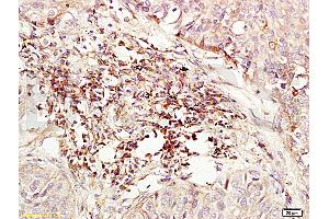 Formalin-fixed and paraffin embedded human lung carcinoma labeled with Anti-CD184/CXCR4 Polyclonal Antibody (ABIN730888), Unconjugated at 1:200, followed by conjugation to the secondary antibody and DAB staining (CXCR4 抗体  (AA 201-294))