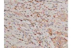 ABIN6267231 at 1/200 staining human breast cancer tissue sections by IHC-P. (IKK alpha 抗体  (pSer176, pSer177))