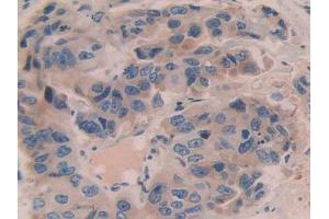 IHC-P analysis of Human Breast Cancer Tissue, with DAB staining. (Contactin 4 抗体  (AA 731-980))