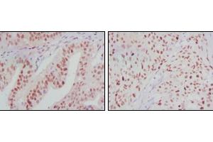 Immunohistochemical analysis of paraffin-embedded human ovarian cancer (left) and breast cancer (right) tissues using ATP2C1 mouse mAb with DAB staining. (ATP2C1 抗体)