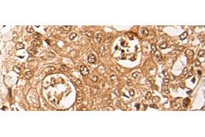 Immunohistochemistry of paraffin-embedded Human prost ate cancer tissue using ZPR1 Polyclonal Antibody at dilution of 1:40(x200) (ZNF259 抗体)