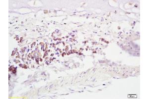Formalin-fixed and paraffin embedded human lung carcinoma labeled with Anti-RNF43 Polyclonal Antibody, Unconjugated (ABIN721600) at 1:200, followed by conjugation to the secondary antibody and DAB staining (RNF43 抗体  (AA 41-140))